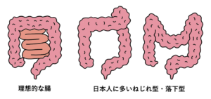 この「ねじれ腸」と「落下腸」は久里浜医療センターの水上健先生が色々なメディアで発信されているものです。
その内容は本来あるべき腸の形状に対して、「ねじれ腸」は文字通り腸がねじれて細くなっているものです。
大腸がねじれてしまうと便が通りにくくなり、ねじれている手前の腸管で便が停滞し便秘が起こります。