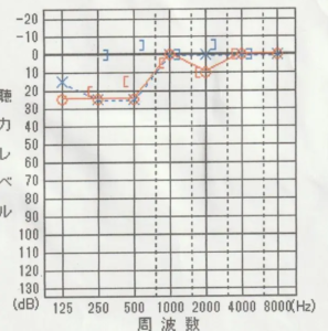 【2回目の問診時】
鍼灸治療により、左耳は1000Hzと8000 Hz が更に5dB 改善される。
本人的にも発症時よりも音の聞こえが良くなったとの実感が確認される。

また左耳は250Hzと500Hz は25dBまで改善され、 右耳も125Hzが30dBから25dB へと改善される。
ほぼ正常値に近い水位まで回復しているが、右耳の耳閉感や音の反響はやや残存している。