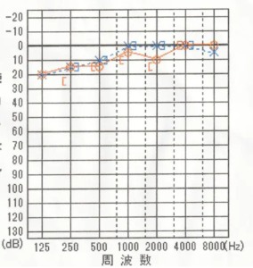 【3回目の問診時】
2回目の施術後に耳鼻科で検査をしたら全て正常値の20dB 以上となり「完治した」との診断を受ける。
本人の自覚的な症状も解消されており、当院でもそれを確認し治療終了を伝える。