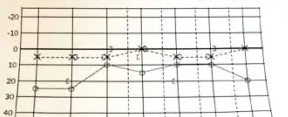 【蝸牛型メニエール病の発症から来院までの経過】
朝起きたら急に耳のつまり感、耳が圧迫された感じが起きていた。
翌日もこの症状が続き3日後に耳鼻科受診するも聴力検査の結果は正常であった。
「異常なし」と言われアデホスコーワとメチコバールのみ処方された。

その後、10日間の旅行をしたり、20年間勤務していた会社が吸収合併されて8月に退職するなど、慌ただしい日々を過ごす。
10日間の旅行中はボーボーと音が鳴る耳鳴りと耳のつまり感の症状がひどく起こった。
旅行から帰り2回目の耳鼻科の診察で聴力検査で難聴と診断される。

35dB位の値が出て「突発性難聴の疑い」との診断でステロイド剤が処方される。
ステロイド剤を服用し一旦は難聴が回復するが、3日後にまた耳のつまり感が再発する。
2週間後に再度診察をすると聴力は悪化していなかったためステロイド剤は処方されず五苓散(漢方薬)が処方された。