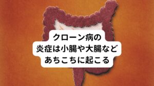 クローン病の症状は、まず小腸や大腸の粘膜に炎症が起こり、消化管の粘膜に潰瘍ができます。
この潰瘍は大腸に近い部分の回盲部（かいもうぶ）と呼ばれる部分や肛門の近くに好発します。
腸の中から体の外へ瘻孔（ろうこう）と呼ばれるトンネルができたり、腸が狭くなったりすることもあります。

また、クローン病の炎症はあちこちで起こるのが特徴です。
炎症は一か所に集中してその一帯に異常が見られることはあまりなく、大腸の中でも正常なところと炎症が起きているところとはっきりしています。