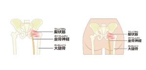 腰椎の下の方から出てお尻を通って足に向かう太い神経を坐骨神経といいます。
坐骨神経が何らかの影響によって圧迫を受けて痛むことを坐骨神経痛といいます。

坐骨神経は主に筋肉や骨によって圧迫を受けることで神経にストレスがかかり痛みが起こります。
圧迫が起こりやすい場所は、腰から出た直後の部分と梨状筋の部分といわれています。