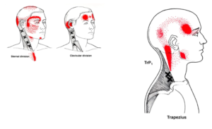 首こりを患っている人は、特に首の横にあるトリガーポイントの筋肉が顎にかけて関連痛を起こす傾向にあります。
とくに首の横にある胸鎖乳突筋は、こめかみや目の周り、顎など広範囲に痛みを出しているのがわかります。

そのため首こりが原因の顎から首にかけての痛みが起きている方は、この胸鎖乳突筋のトリガーポイントが治療対象になります。
また右側の画像にある僧帽筋のトリガーポイントは肩こりの代表筋です。

この胸鎖乳突筋や僧帽筋は首や肩こりの人は、必ず治療対象となるトリガーポイントです。
これらのトリガーポイントの図のように必ずしも痛みを出すとは限りませんが一つの指標として治療します。
顎でも首でも同じような部位に関連痛を起こしていることが理解いただけたのではないでしょうか。